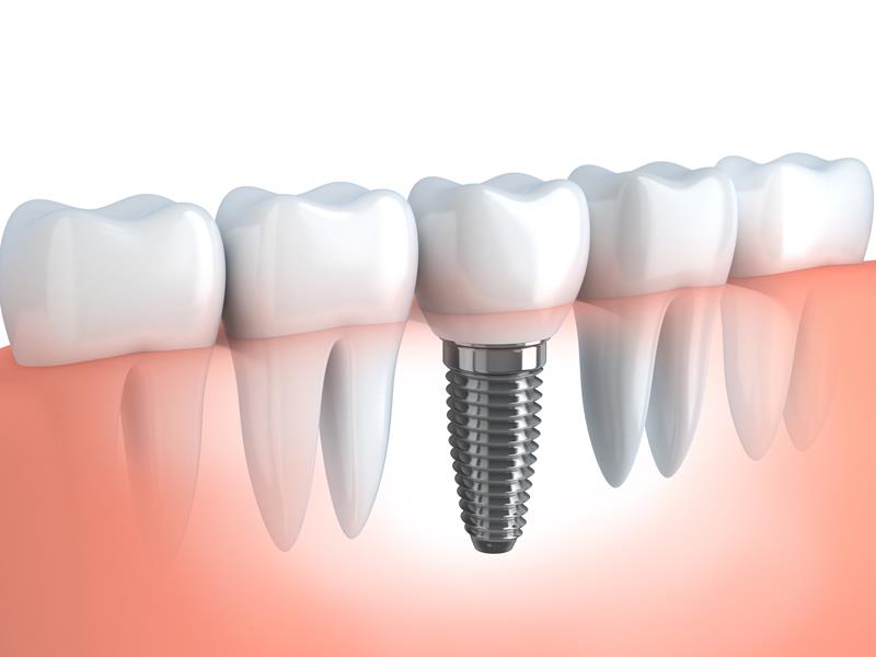 Dental Implants Kingsport TN 